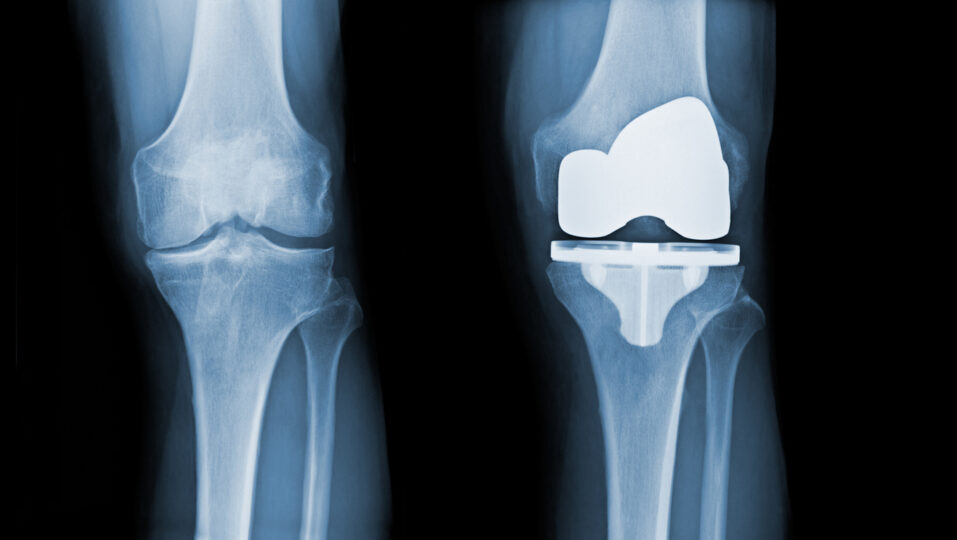 Before & After — Severely arthritic knee restored to precise implant alignment