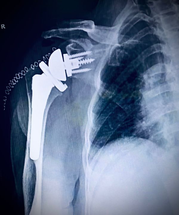 Reverse Total Shoulder Arthroplasty (rTSA) — overhead function fully restored