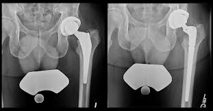 Both hips replaced simultaneously — patient walking within 24 hours