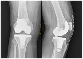 Both knees reconstructed in a single surgical session