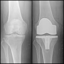 Bone-on-bone arthritis to perfectly aligned implant — single-stage procedure