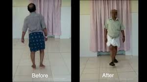 Before & After — Severe bow-leg (varus) fully corrected, patient walks straight