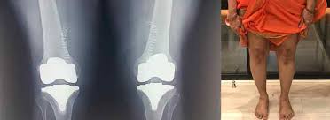 Post-op X-ray alongside patient's fully corrected limb alignment
