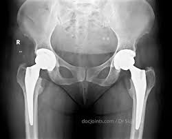 Simultaneous bilateral hip arthroplasty — zero complications