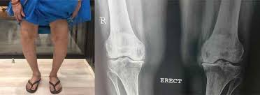 Severe varus deformity — weight-bearing X-ray before corrective surgery