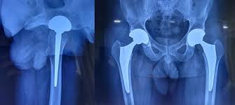Failed native hip (left) vs. precision-implanted total hip arthroplasty (right)