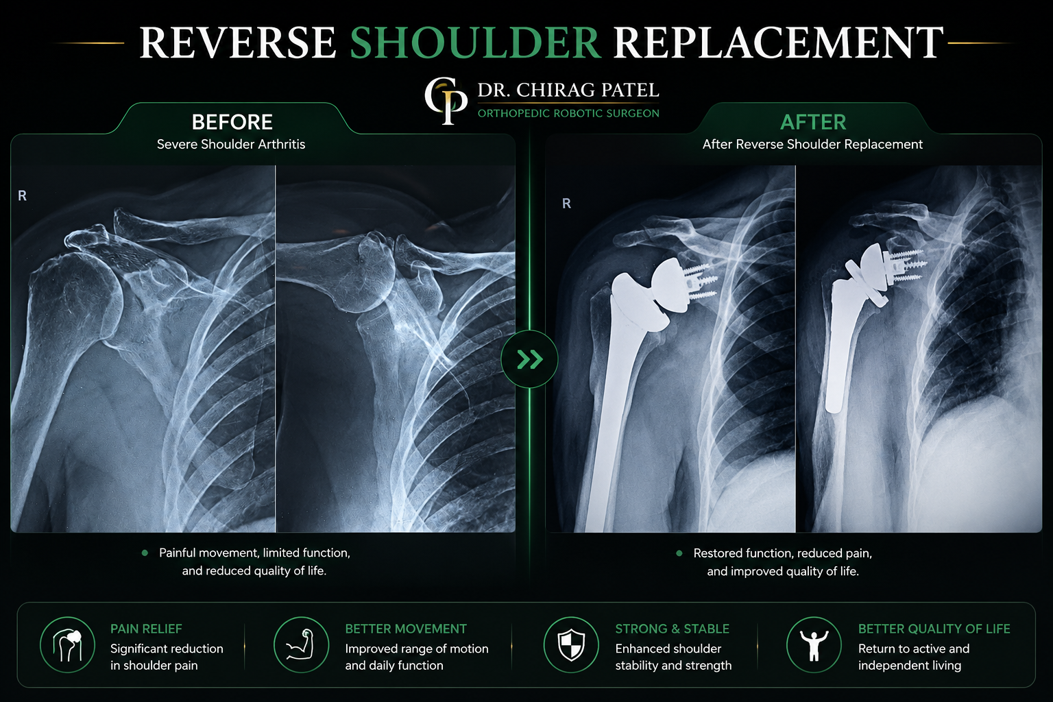 Reverse Shoulder Replacement